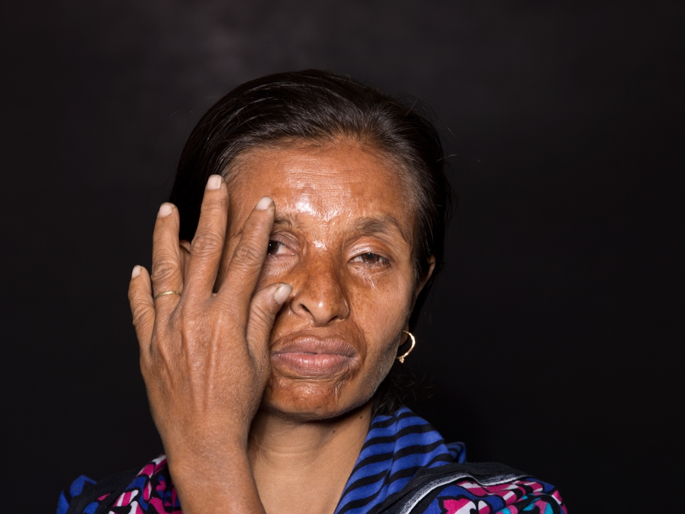 Scandalous Acid Victims , Bangladesh