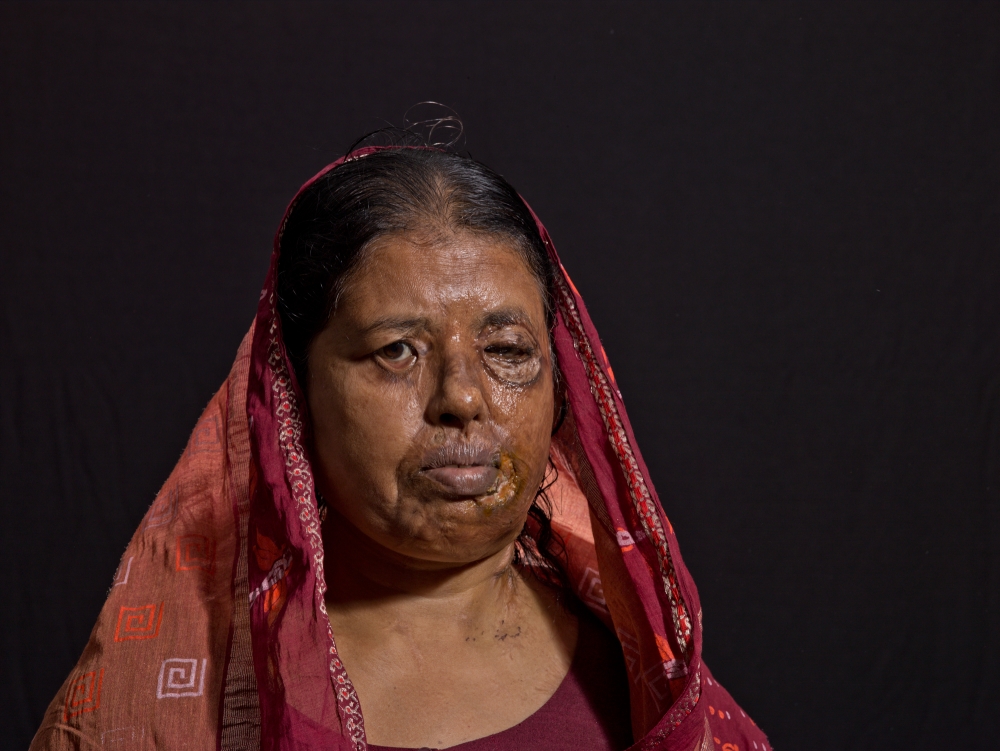 Scandalous Acid Victims , Bangladesh