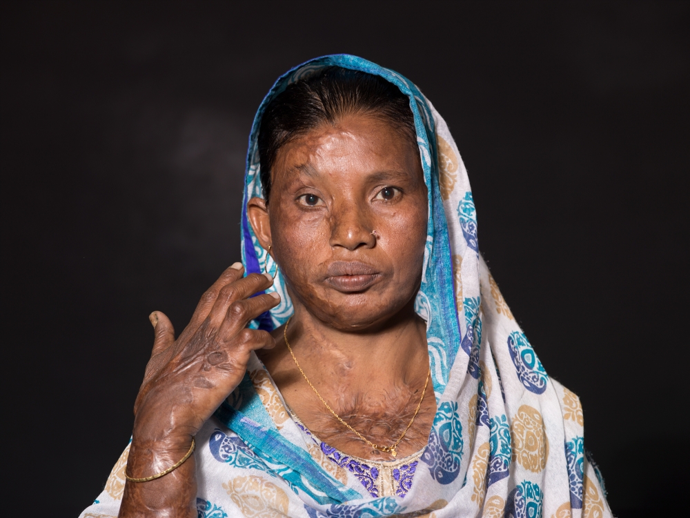 Scandalous Acid Victims , Bangladesh